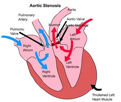 Aortic Stenosis