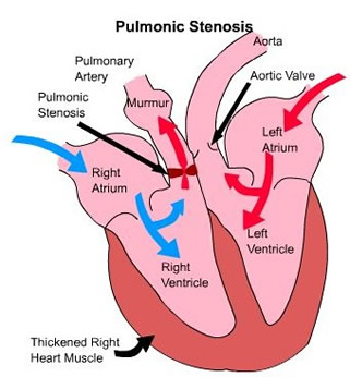 Pulmonic Stenosis